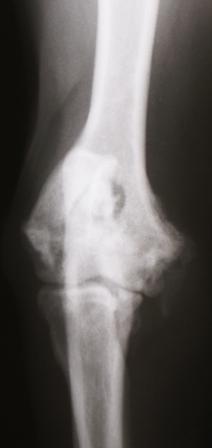 Arthritis in an elbow